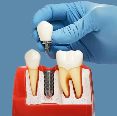 Can-You-Get-Dental-Implants-Covered-by-Insurance-in-Weston,-FL