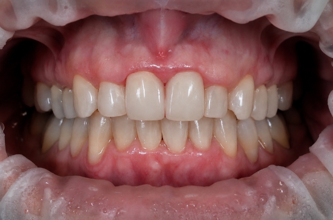 Smile after dental treatment – case 1