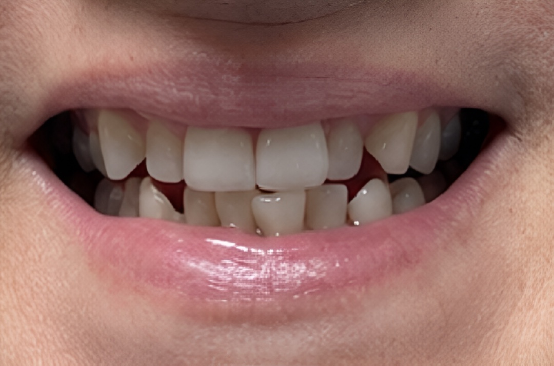 Smile before dental treatment – case 1