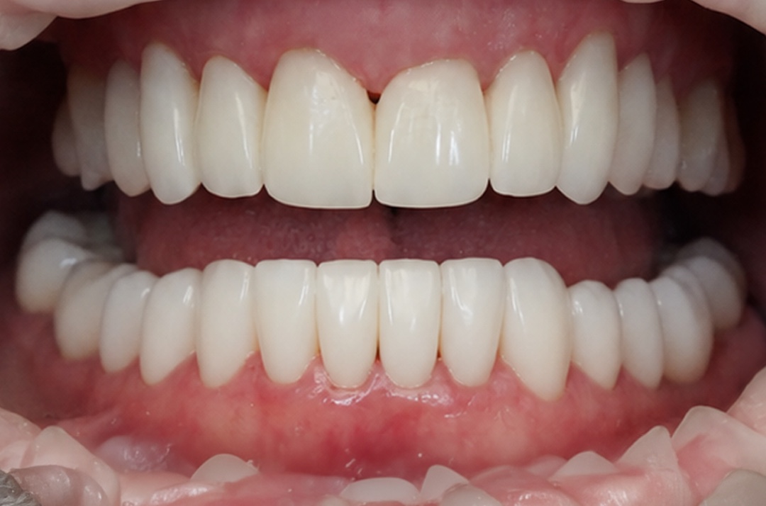 Smile after dental treatment – case 2