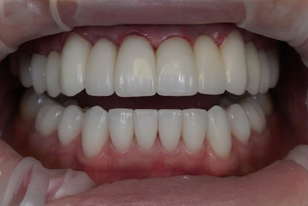 Smile after dental treatment – case 3
