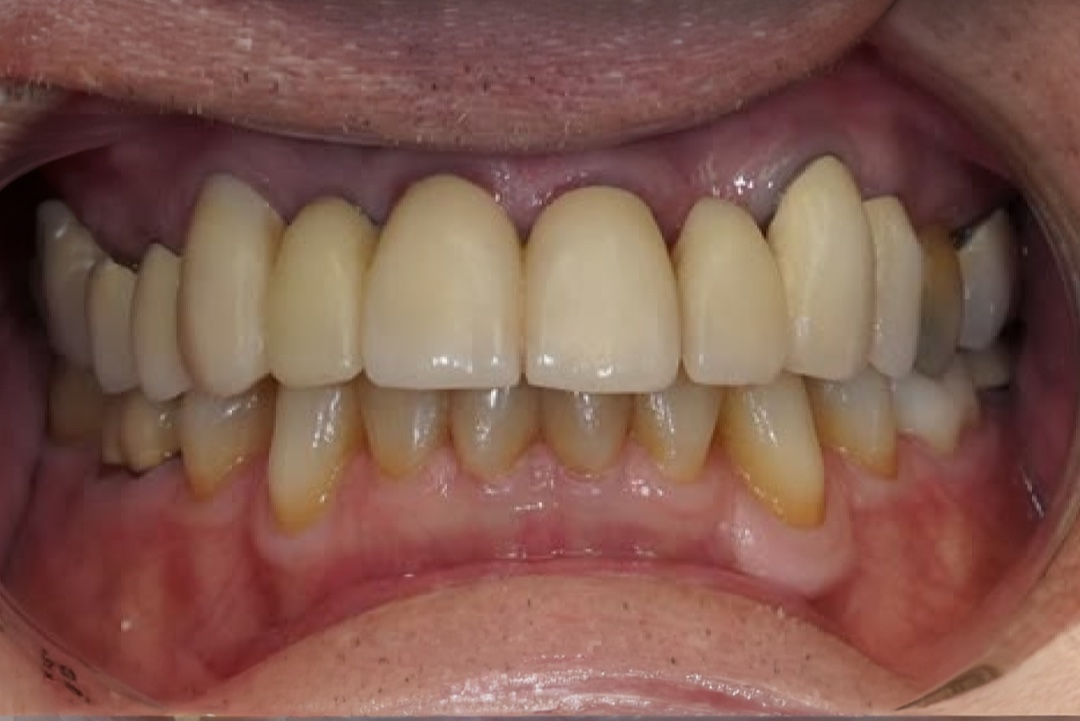 Smile before dental treatment – case 3