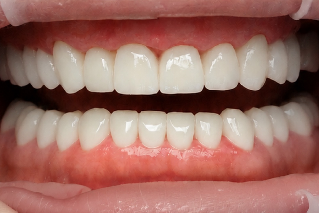Smile after dental treatment – case 4