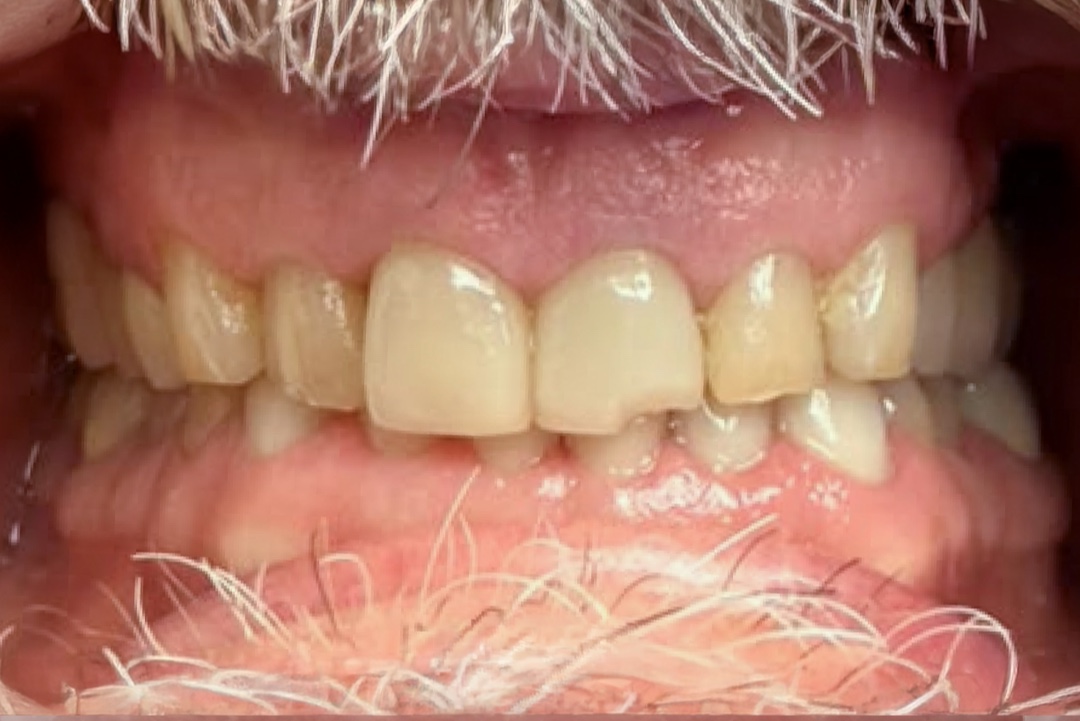 Smile before dental treatment – case 4