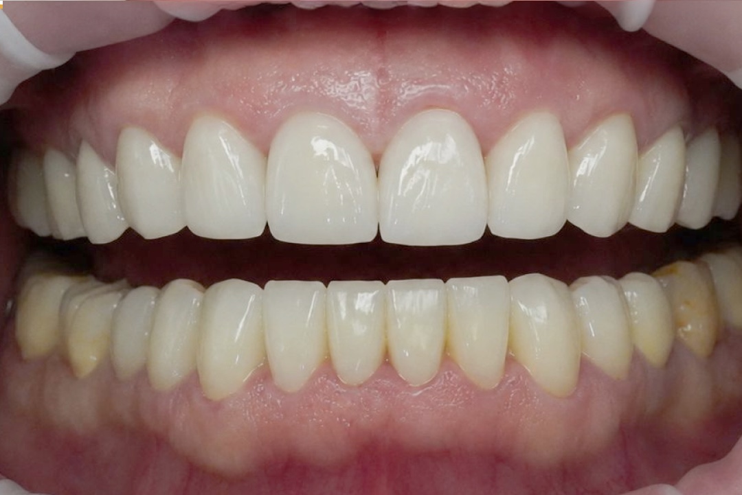 Smile after dental treatment – case 5