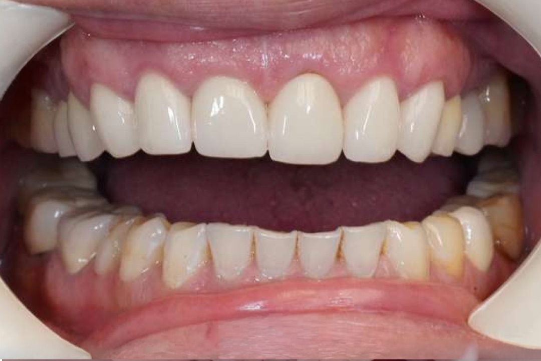 Smile before dental treatment – case 5