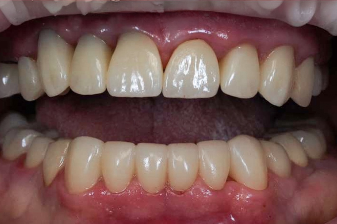 Smile after dental treatment – case 6