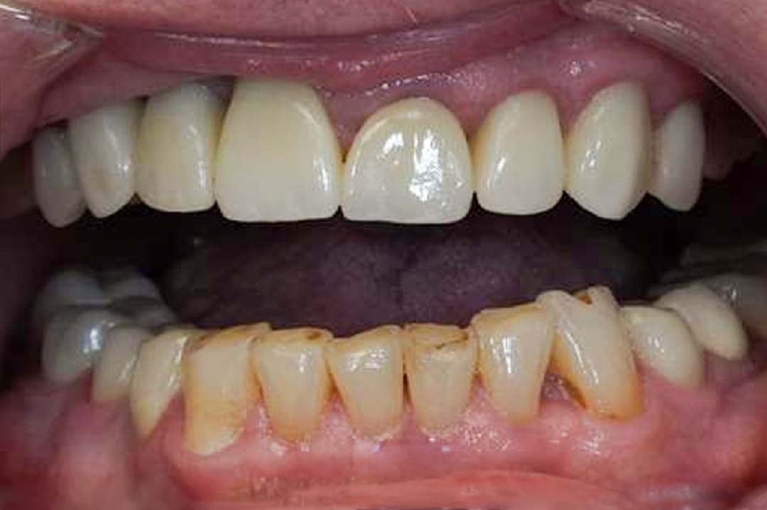 Smile before dental treatment – case 6