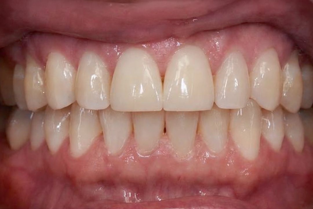 Smile after dental treatment – case 7