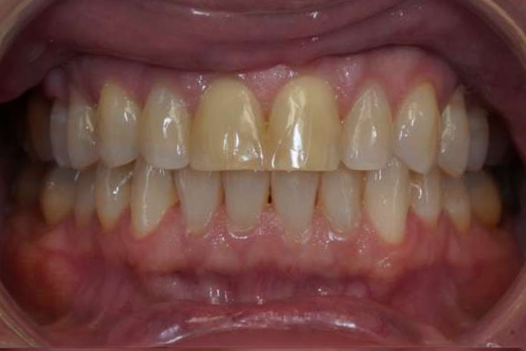 Smile before dental treatment – case 7