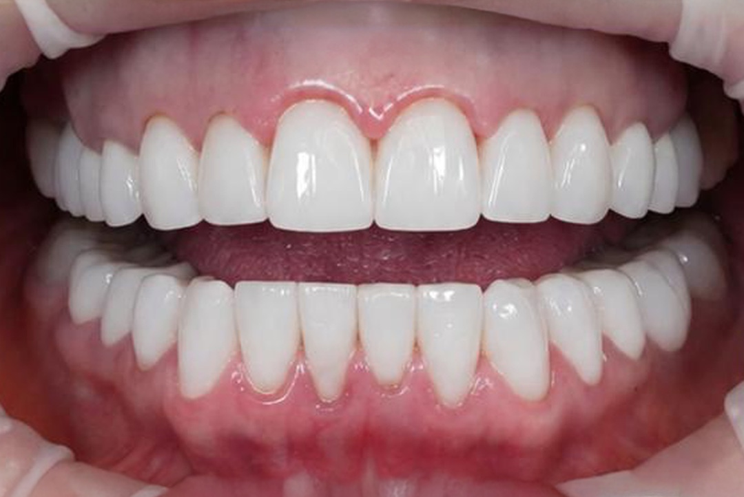 Smile after dental treatment – case 8