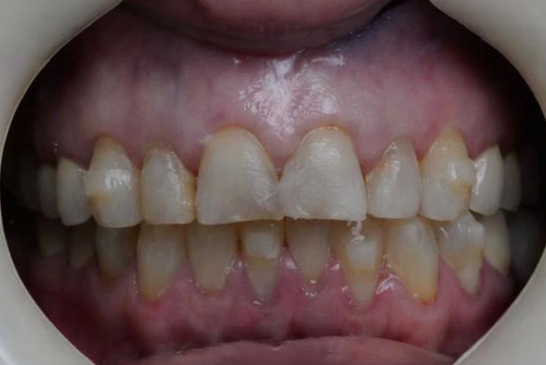 Smile before dental treatment – case 8