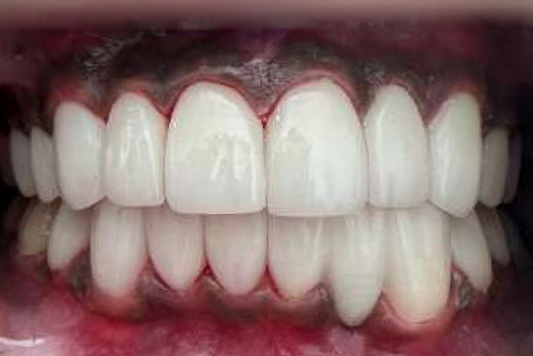 Smile after dental treatment – case 9